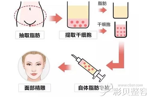 自体脂肪填充面部过程