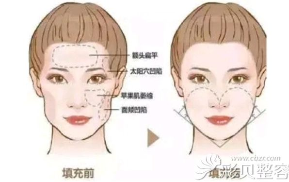 自体脂肪面部填充前后效果对比