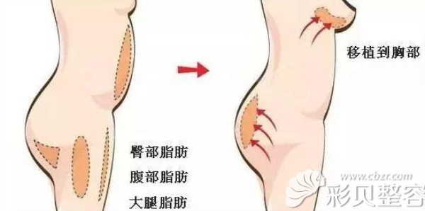 自体脂肪移植隆胸