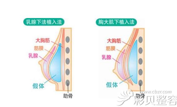 隆胸假体放置的位置