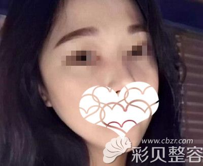 颧骨高做了颧骨内推术后两年效果