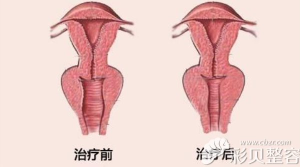 子宫脱垂手术子宫下垂图片
