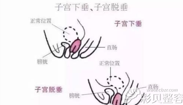 我产后前后壁膨出子宫下垂花10万做后方膣圆盖术就修复了