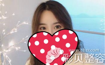 去韩国做脂肪填充额头过量失败修复