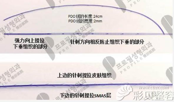 手术中用的倒刺线