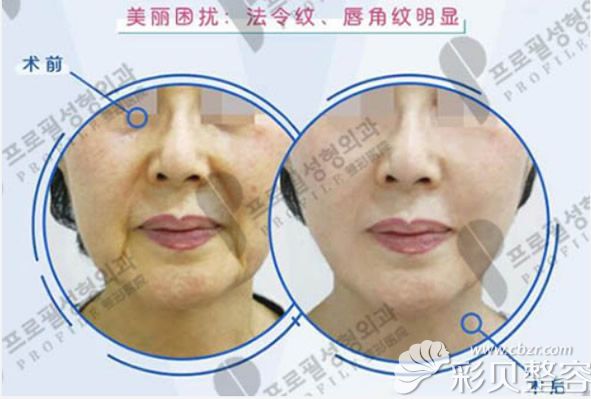 50岁的人做完小切口提升后的恢复图