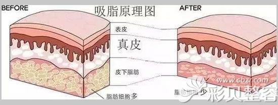 吸脂原理图