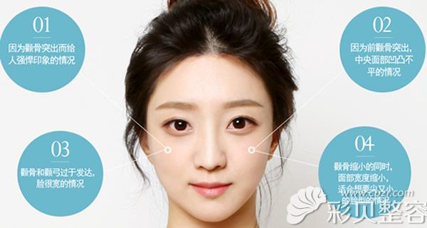 无删截颧骨缩小术适应人群