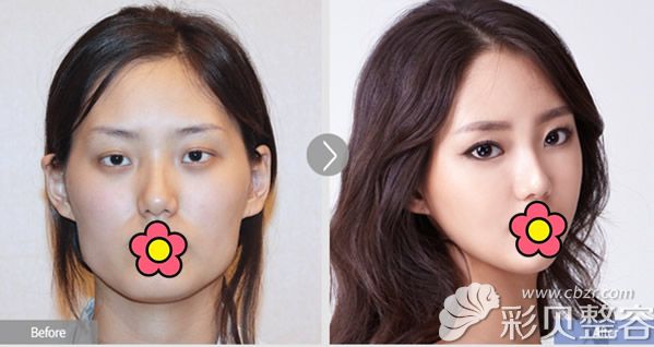 颧骨内推对比照片