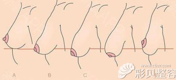 矫正乳房松弛下垂的方法