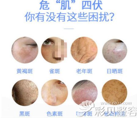 郑州华山医院刘芳激光祛斑治疗不同斑类型