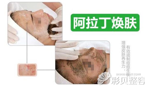 韩国UCC阿拉丁焕肤能淡斑吗？术后会不会对皮肤有伤害？