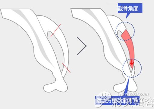 无删截提升颧骨缩小手术原理