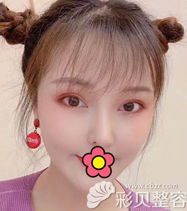 割双眼皮40天的恢复图