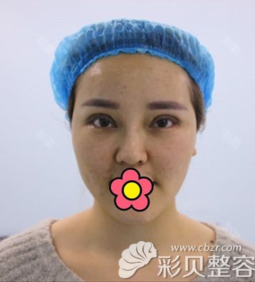 三点定位双眼皮第1天眼睛红肿