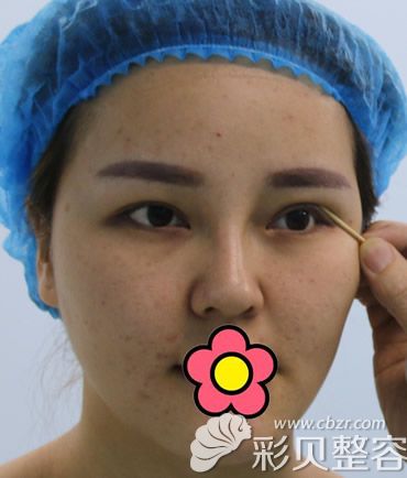 做双眼皮前照片
