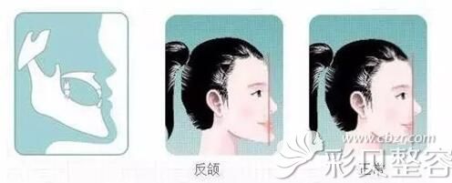 地包天矫正手术后<span style=