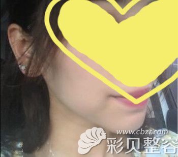 假体垫下巴2个月告别凸嘴,笑容好看,说话也利索了 假体垫下巴2个月告别凸嘴,笑容好看,说话也利索了