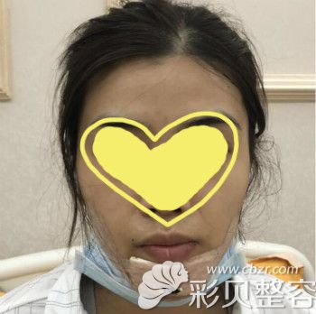 做完垫下巴当天效果 做完垫下巴当天效果