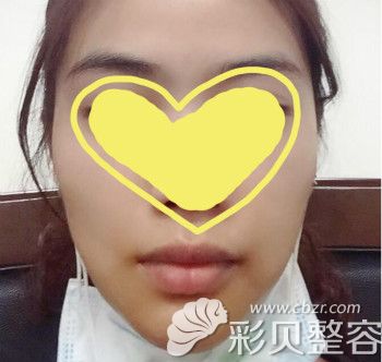 硅胶假体垫下巴第3天效果 硅胶假体垫下巴第3天效果