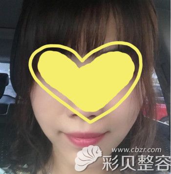 硅胶假体垫下巴20天效果 硅胶假体垫下巴20天效果