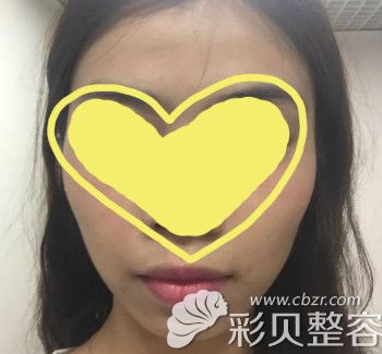 硅胶垫下巴手术前照片 硅胶垫下巴手术前照片