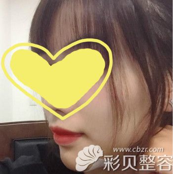 假体下巴拆线即刻效果图 假体下巴拆线即刻效果图