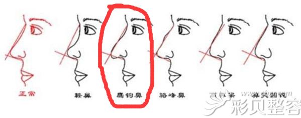 正常鼻子和畸形鼻的区别
