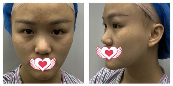 山根凹陷,做了耳软骨加硅胶隆鼻三个月后脸型也有很大变化