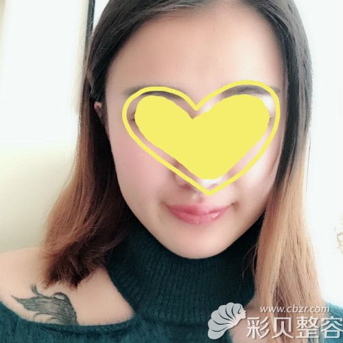 做m唇手术后第11天恢复效果