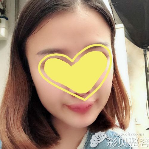 m唇手术第5天照片