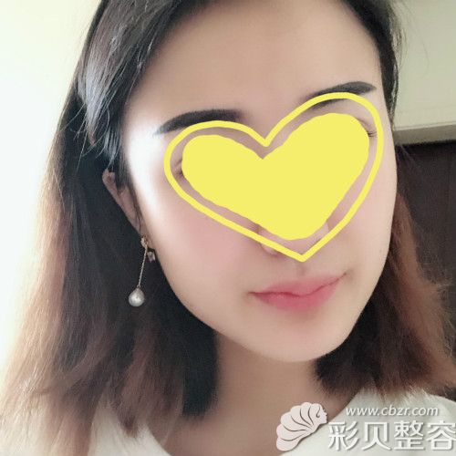 做了微笑M唇手术第20天效果图