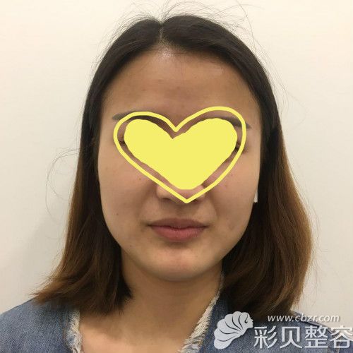 我做m唇手术前唇部照片