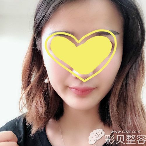 做m唇一个月效果自然无疤痕，嘴角上扬