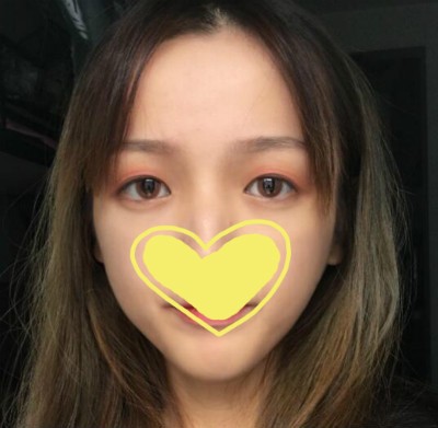 我眼综合术后4个月真实恢复期图片,诉说做眼综合花15000贵吗