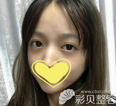 花15000做的眼综合术后二十五天效果