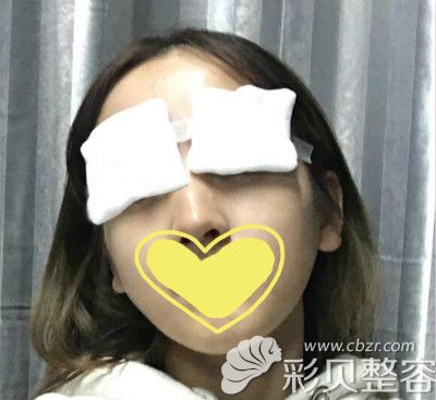 眼综合手术即刻效果图