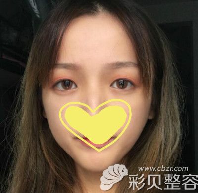 做眼综合手术前照片