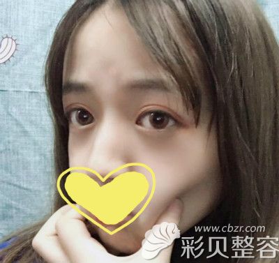 做眼综合2个月恢复图片