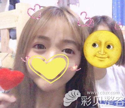 15000做的眼综合术后四个月效果，是不是很自然