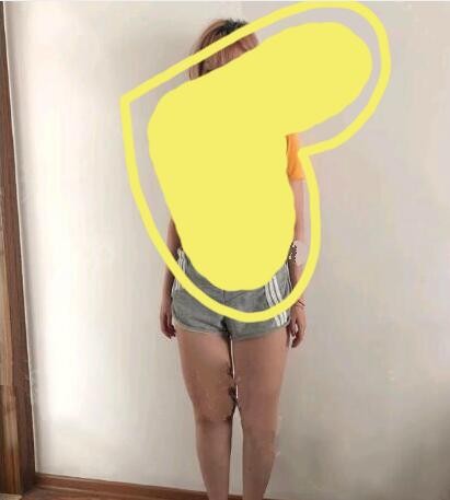 大腿太粗抽脂亲身经历图片分享,三个月后大腿围49.5cm定型了