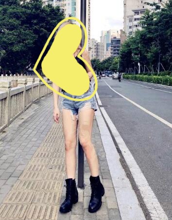 大腿太粗抽脂亲身经历图片分享,三个月后大腿围49.5cm定型了