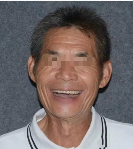 案例:60多岁全口牙缺失的张爷爷,做德国4D种植牙的真实感受