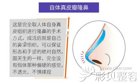 自体真皮隆鼻利弊