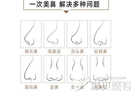 自体真皮隆鼻解决鼻部多种问题
