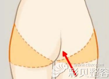 自体真皮隆鼻真皮取的部位是臀沟