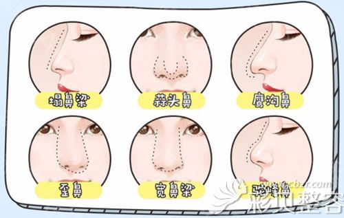 隆鼻改善鼻部问题