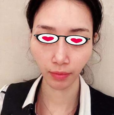 用自体脂肪填充太阳穴前,我是一个额头窄太阳穴凹陷的女人!