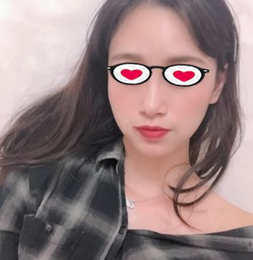 用自体脂肪填充太阳穴前,我是一个额头窄太阳穴凹陷的女人!