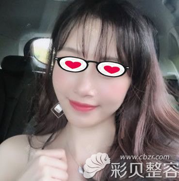 脂肪填充15天恢复照片